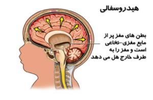 بیماری آب آوردن جمجمه یا «هیدروسفالی» چیست/سلامت