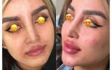 تزریق ژل لب مدل روسی | مزایا، عوارض، ماندگاری، مراقبت ها و هزینه