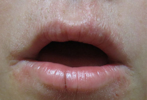 مهم‌ترین علل خشکی لب‌ چیست/سلامت