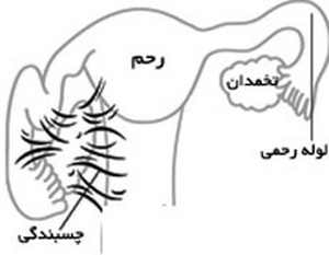 آیا چسبندگی رحم نازایی به وجود می آورد/سلامت آیا چسبندگی رحم نازایی به وجود می آورد/سلامت