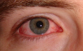 عامل ورم ملتحمه چشم چیست/سلامت